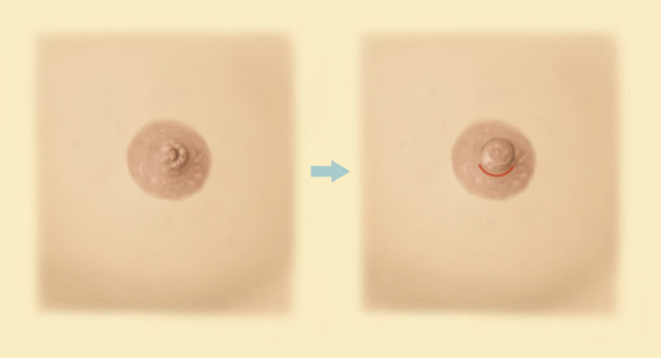 Inverted Nipple Repair - Farber Plastic Surgery