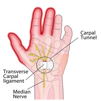 Picking A Good Carpal Tunnel Surgeon