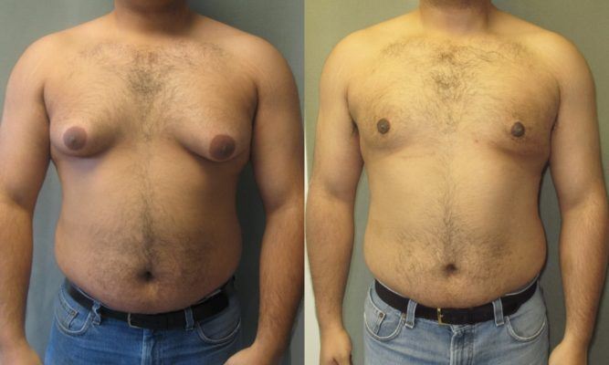 Male Breast Reduction Surgery Gynaecomastia liposuction Cape Town