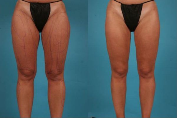 Inner Thigh Lift Scars and Medial Thigh Lift Scars