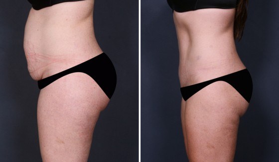 Tummy Tuck Dr Gideon Maresky(Abdominoplasty, Liposuction)