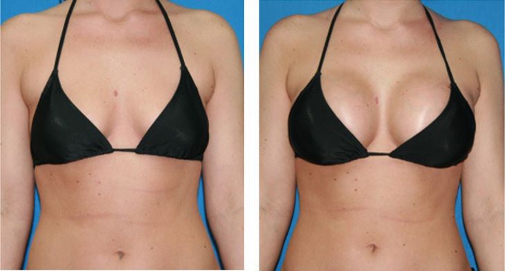 Natural Looking Breast Implants, Breast Enlargement, Augmentation