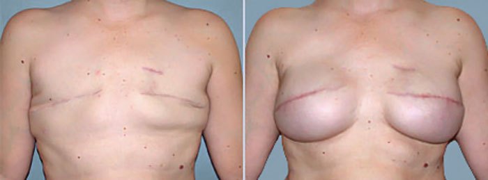 Breast Reconstruction After Mastectomy