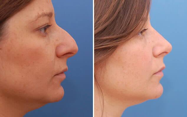 47++ Average price of a nose job ideas in 2021 