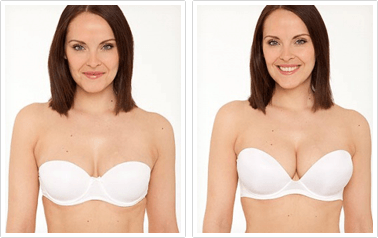 Breast Lift Results After 40  Dr. Smita SR Plastic Surgery