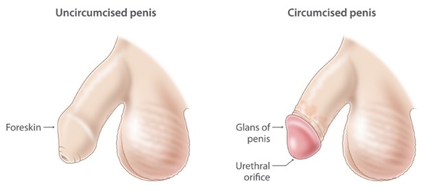 Penis before and after circumcision - Mayo Clinic